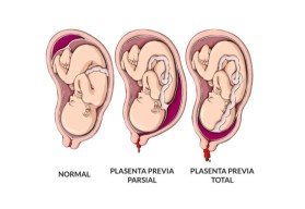 Alami Plasenta Pervia, Kelahiran Bayi Warga Menganti Ini Prematur