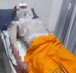 Nekat Bermain Petasan, Pemuda di Driyorejo Alami Luka Bakar Serius